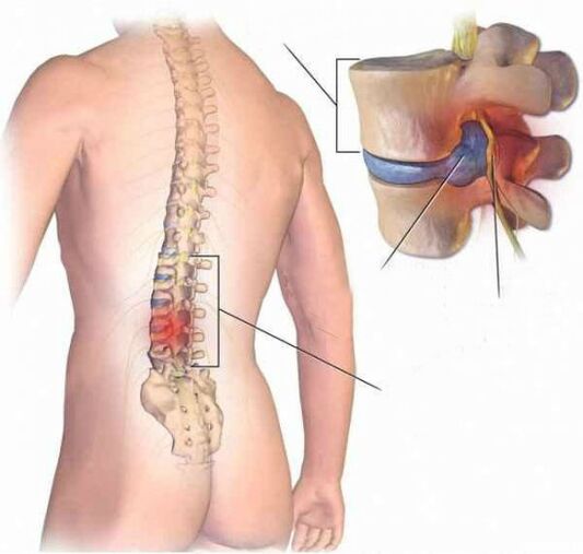 Hérnia intervertebral